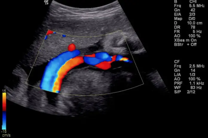 Ecografía Doppler color obstétrico
